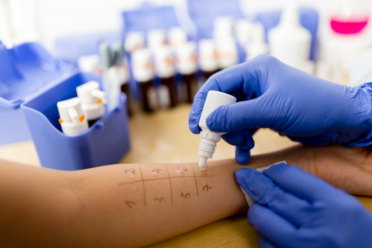 Where to Take Allergy Test? Best Guide