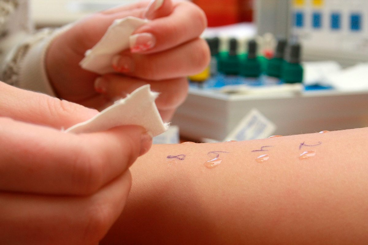 Where to Take Allergy Test? Best Guide