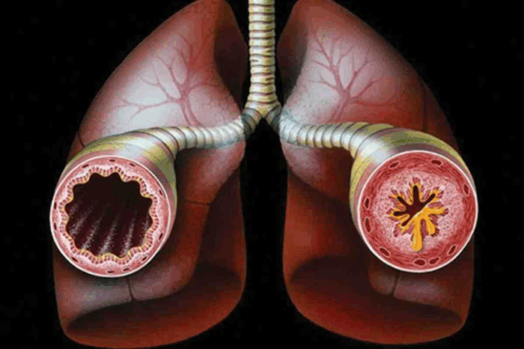 Can Bronchitis Cause Asthma? Critical Facts