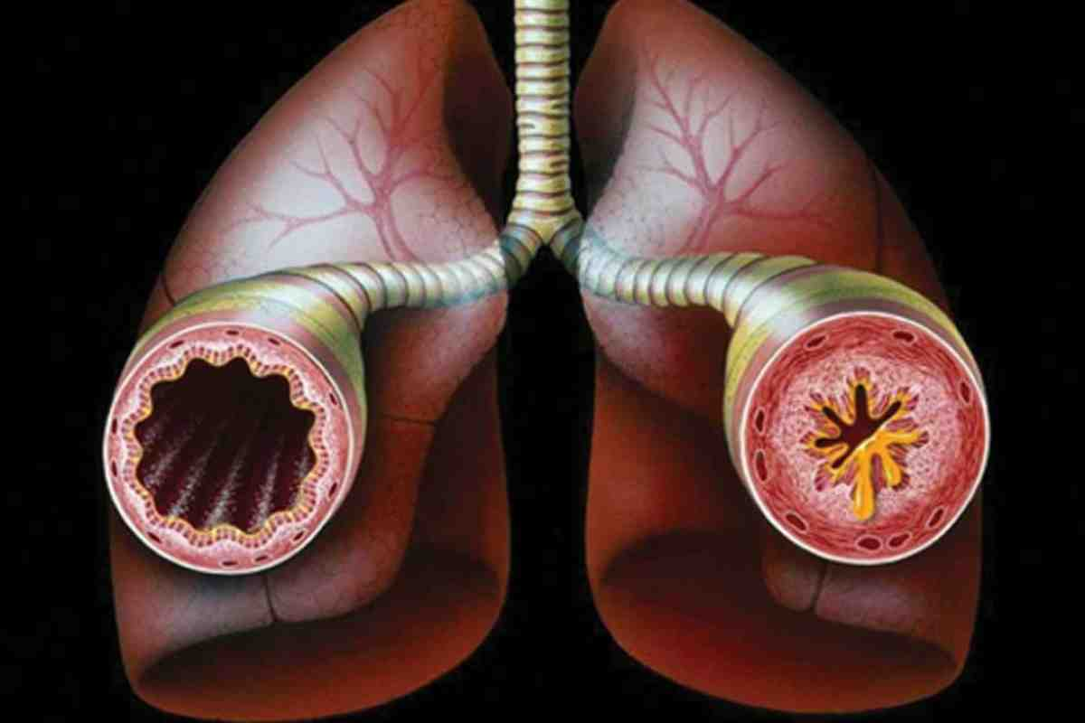 Can Bronchitis Cause Asthma? Critical Facts