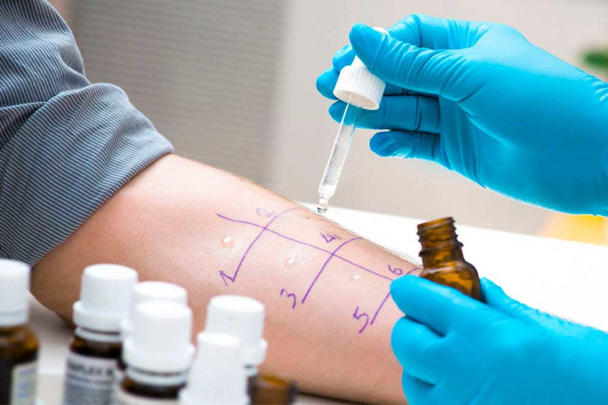 Blood Test for Allergic Reaction: Vital