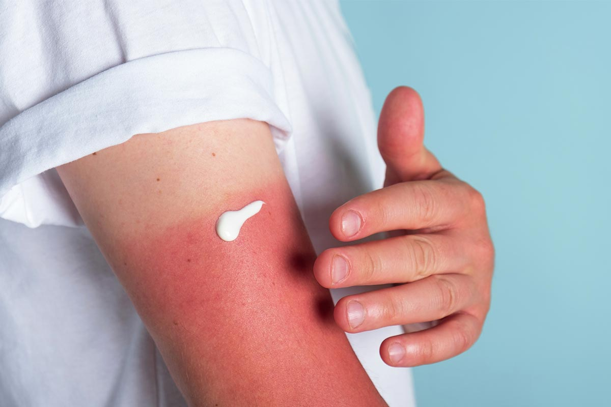 Anti Itch Skin Cream: Best Use Guide 2 word image 229470 2 LIV Hospital