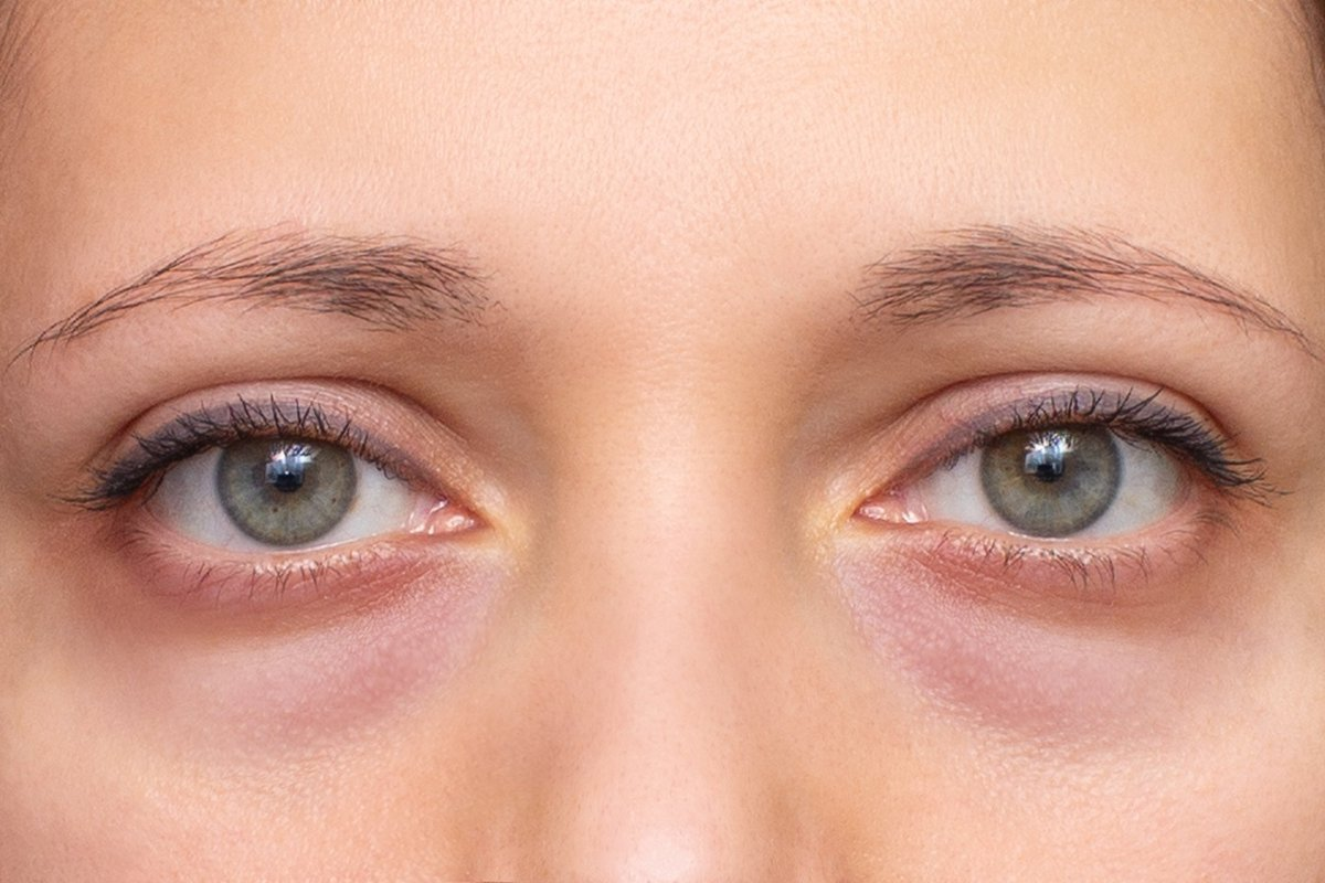 Allergies vs Pink Eye: Vital Distinction