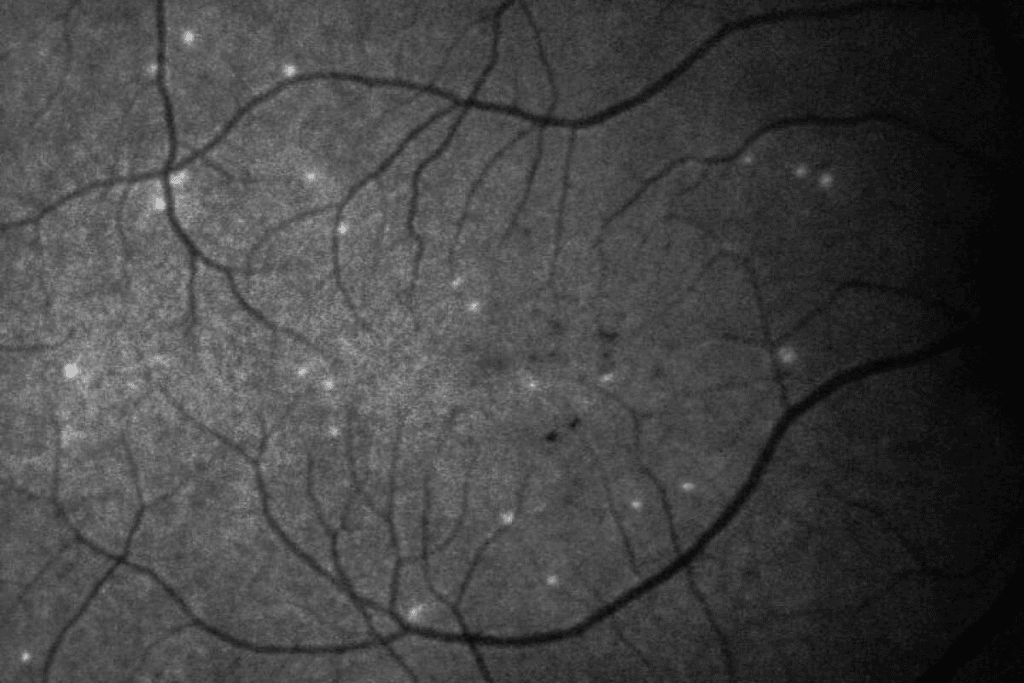 Edematous optic disc: 5 Dangerous Causes
