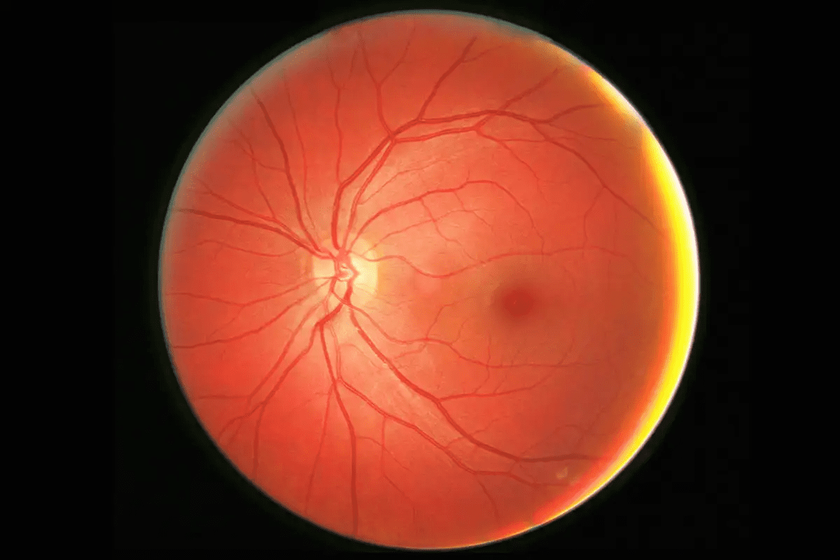 Fascinating Are Eye Floaters And Macular Degeneration Connected?