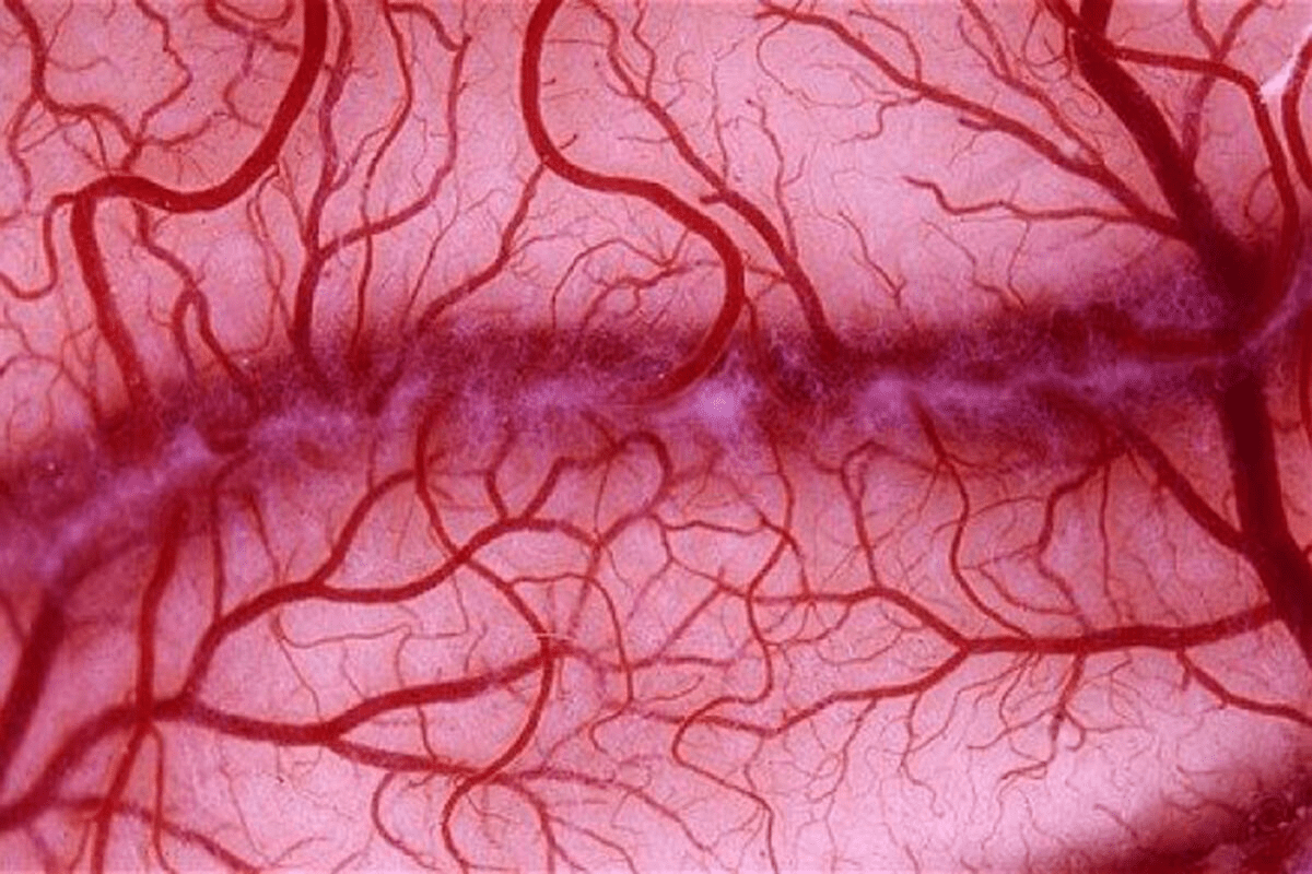 Profound What Causes Enlarged Blood Vessels Behind The Eye?