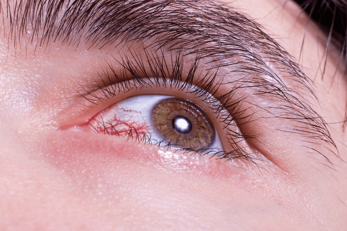 Essential What Causes Enlarged Blood Vessels In Eye?