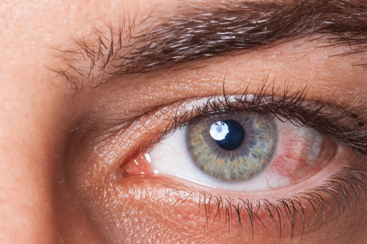 Guide 5 Ways To Identify Anterior Chamber Cells & Flare