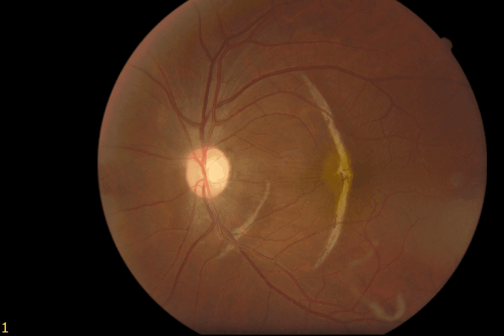 Retinal membrane: The Ultimate ERM Guide 2 Retinal membrane: The Ultimate ERM Guide
