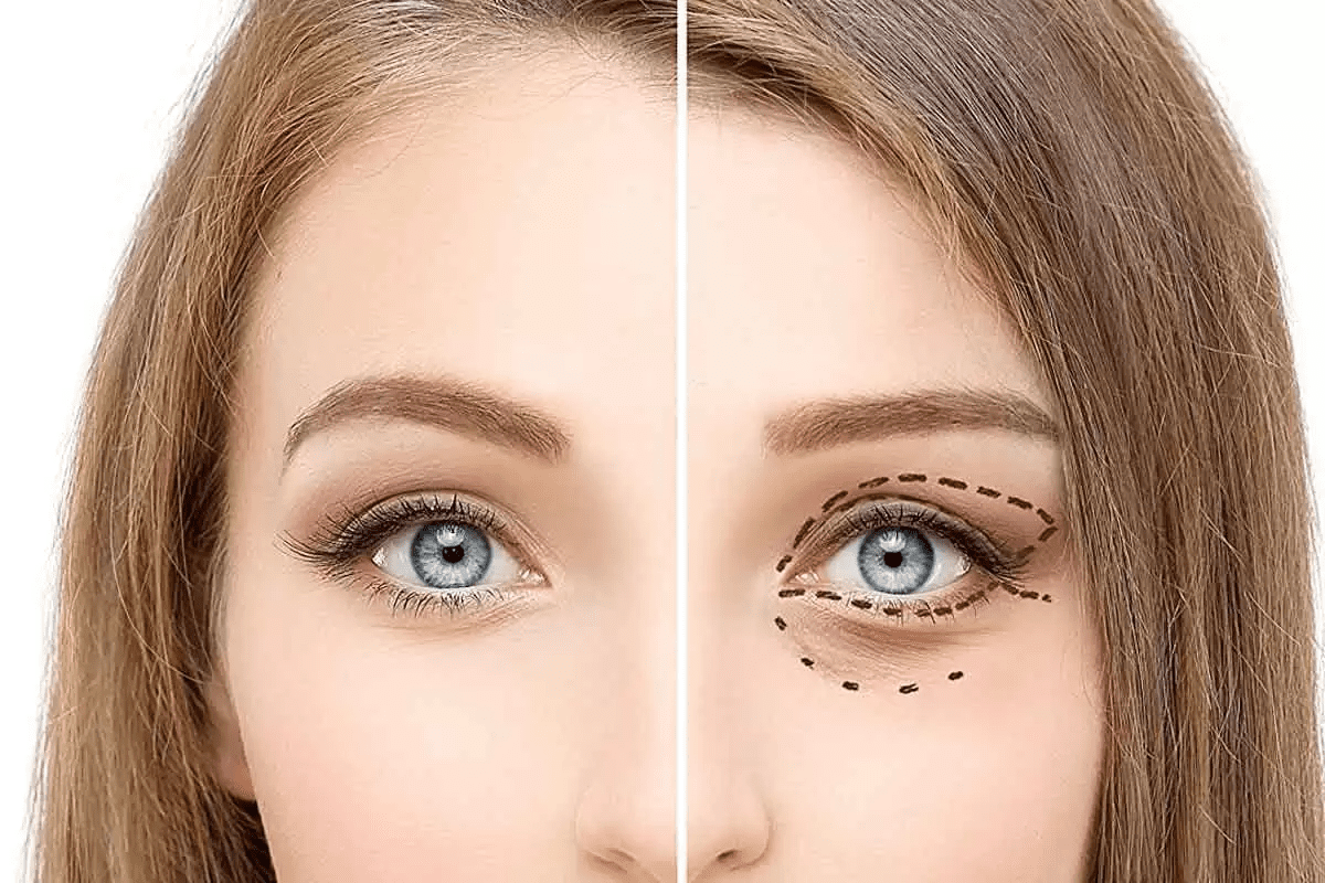 Double eye fold surgery: An Essential Guide