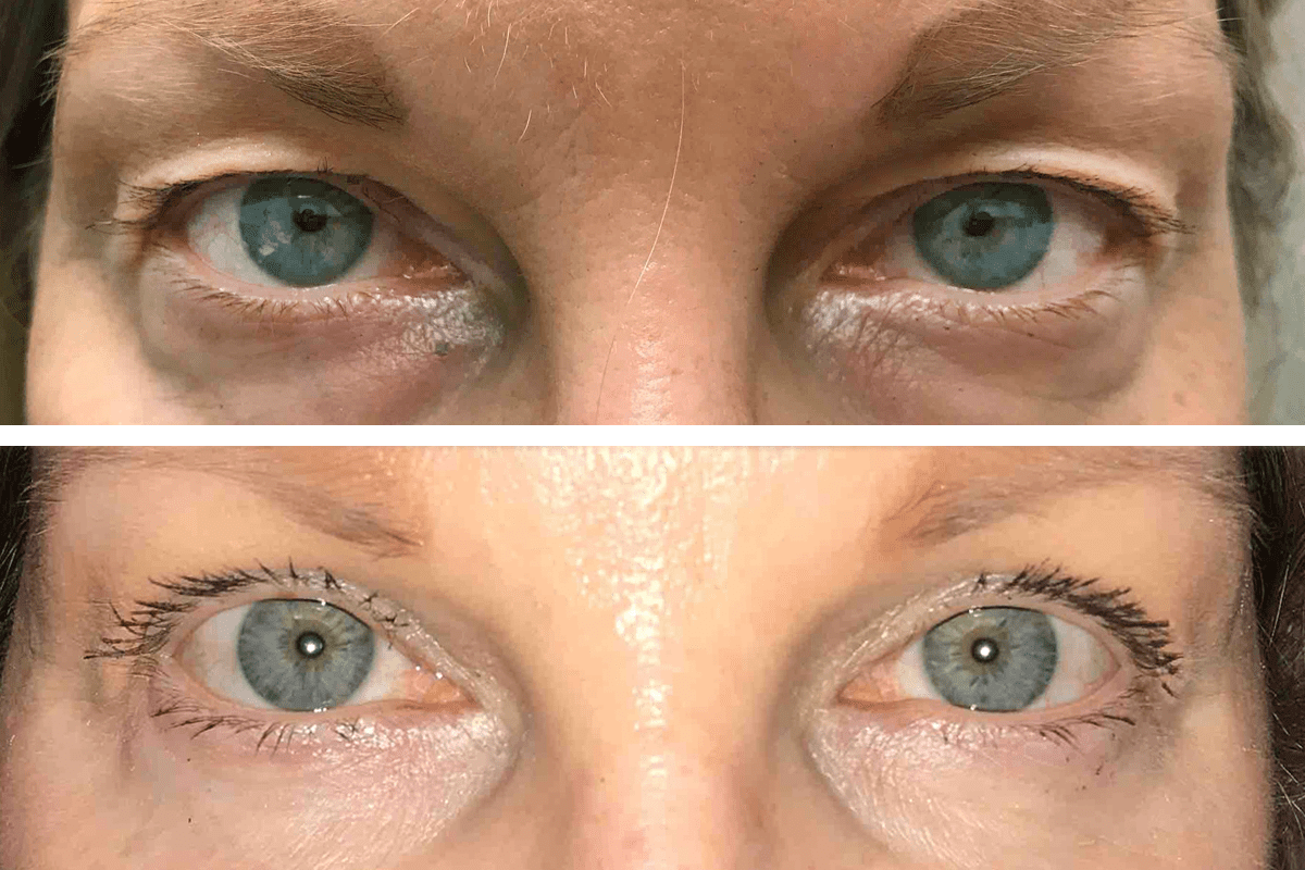 Double eyelid surgery: The Ultimate Asian Eye Guide