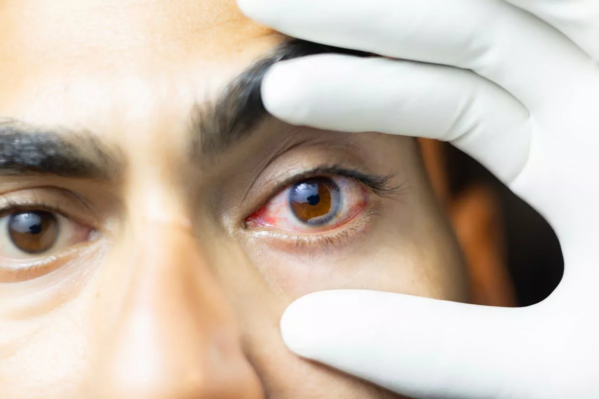 Burst blood vessel behind eye: Dangerous Causes
