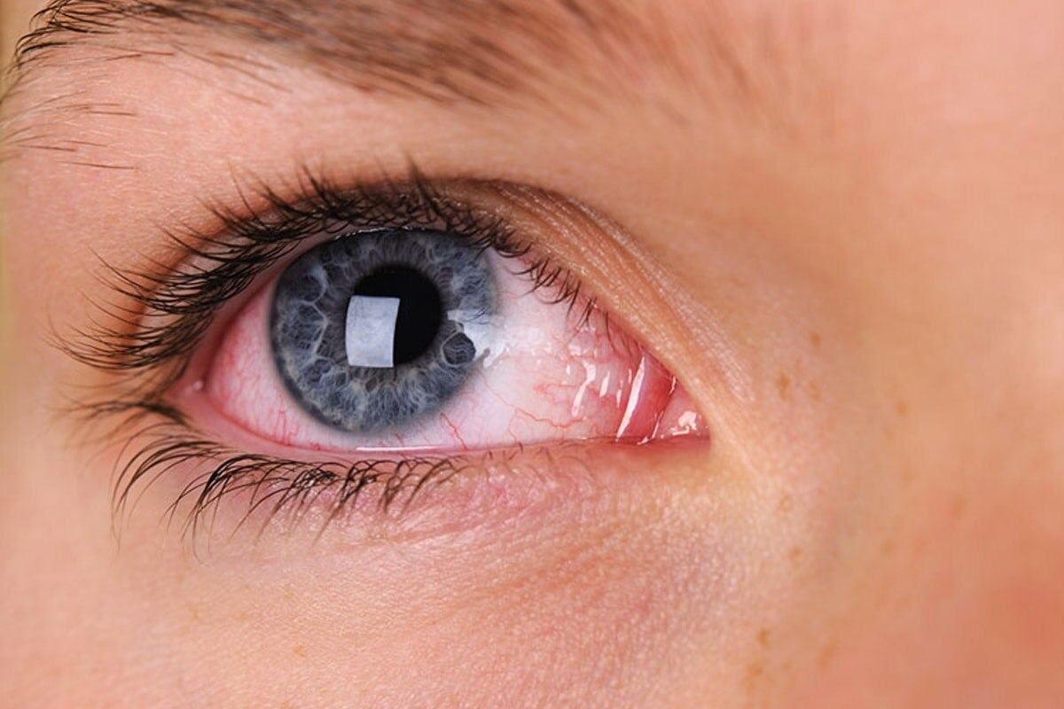 Blood clot in eye symptoms: 5 Warning Signs