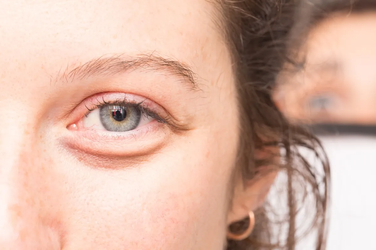 ERM eye symptoms: 5 Key Warning Signs