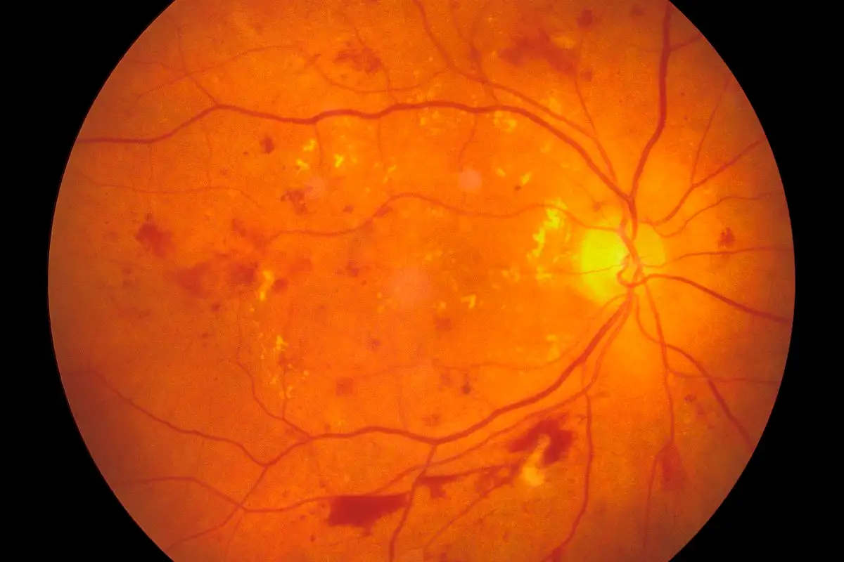 ERM ophthalmology: The Ultimate Guide to ERM