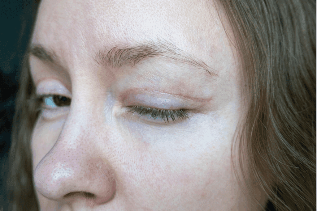 Guide How To Achieve Blepharoplasty Scar Healing