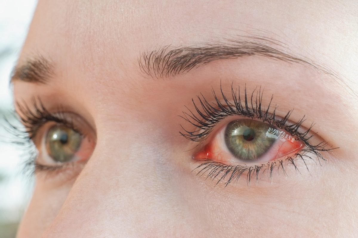 Fascinating How To Treat Inside Of Eye Red And Swollen