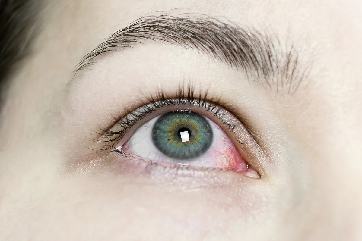 Profound 15 Worst Rare Eye Diseases: Complete Guide