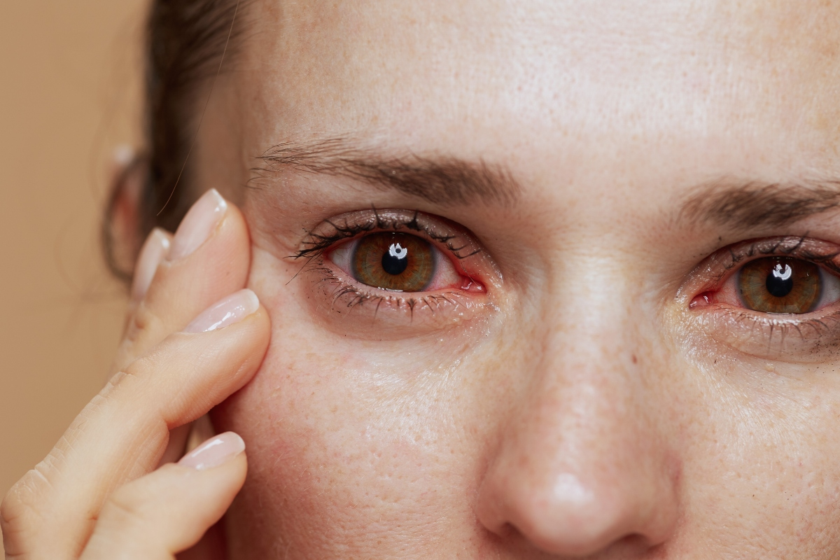 Essential How To Treat Bloodshot Disease With Red eyes: Relief Guide