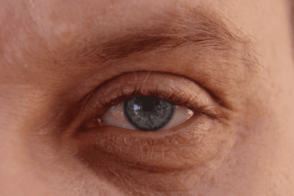 Retinal wrinkle: The Ultimate Macular Pucker Guide