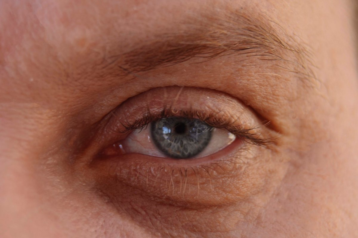 Retinal wrinkle: The Ultimate Macular Pucker Guide