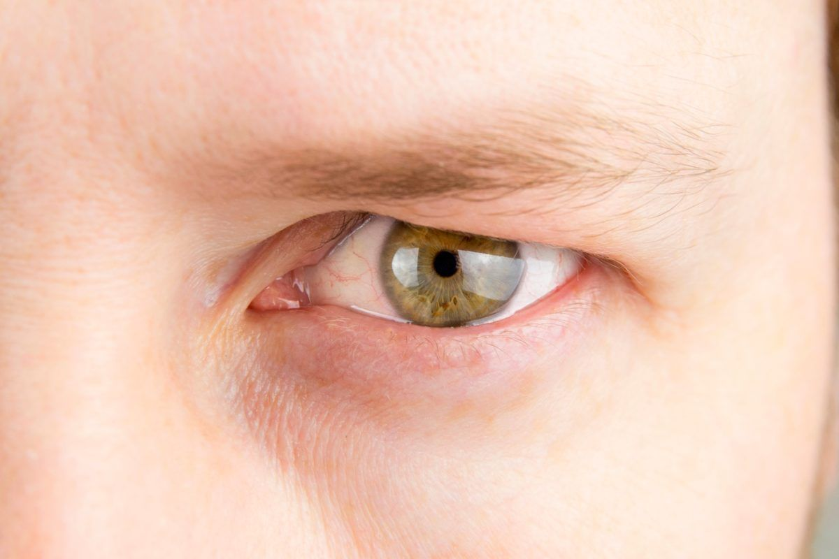 Crucial What Causes A Leaking Blood Vessel In Eye To Burst?
