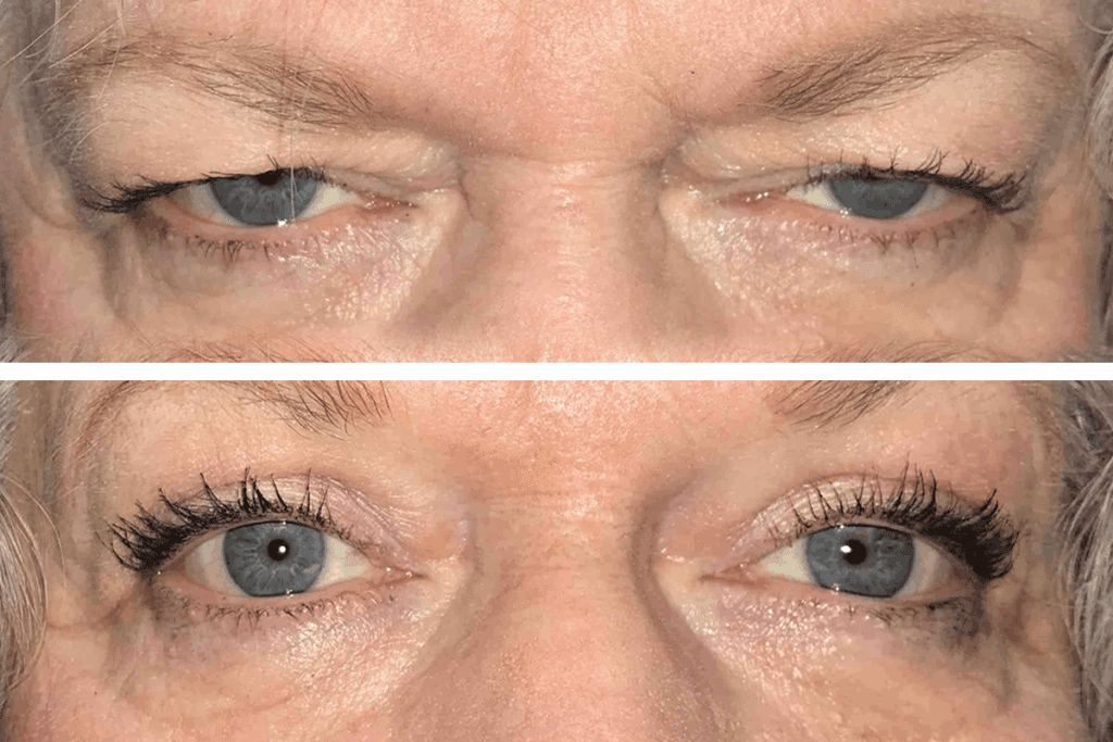 Blepharoplasty Surgery Complications: 7 Dangers