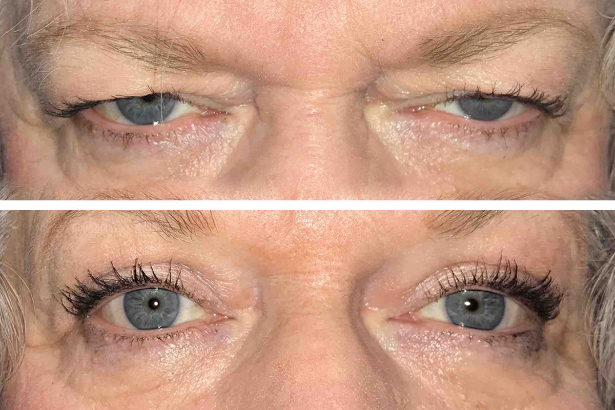 Blepharoplasty Surgery Complications: 7 Dangers