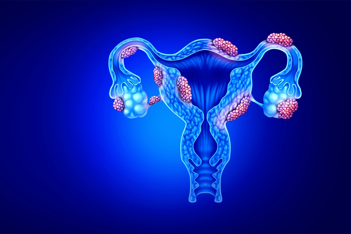 Does PCOS Cause Heavy Bleeding? Alarming Truth