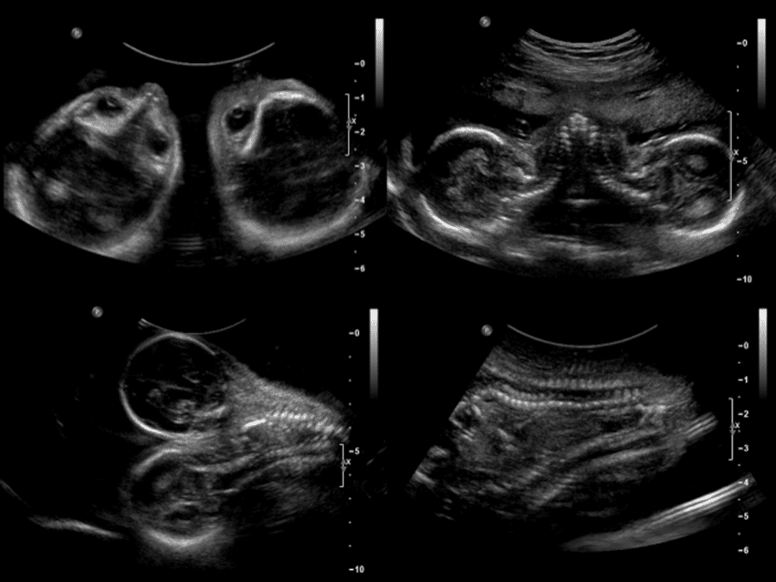 Intrauterine Insemination Twins: Surprising Odds