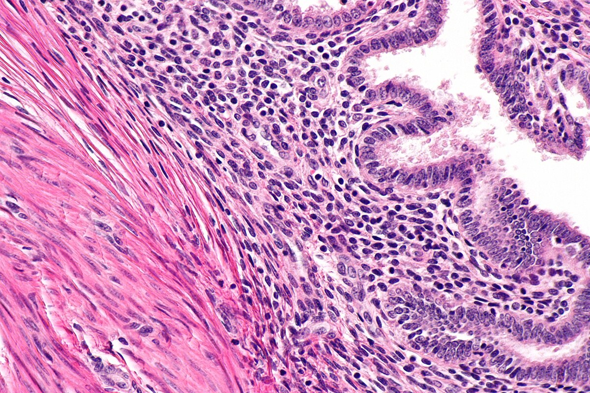 What Are the Most Effective Adenomyosis Treatment Options?