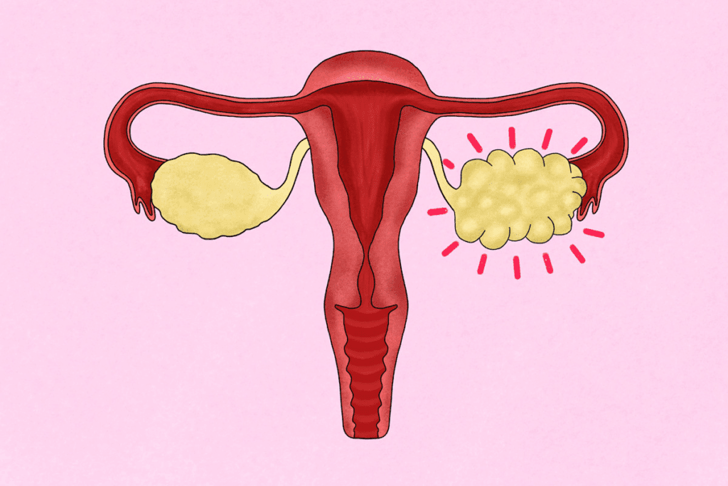 Ovarian Discomfort After Menopause: Best Fixes 1 Ovarian Discomfort After Menopause: Best Fixes
