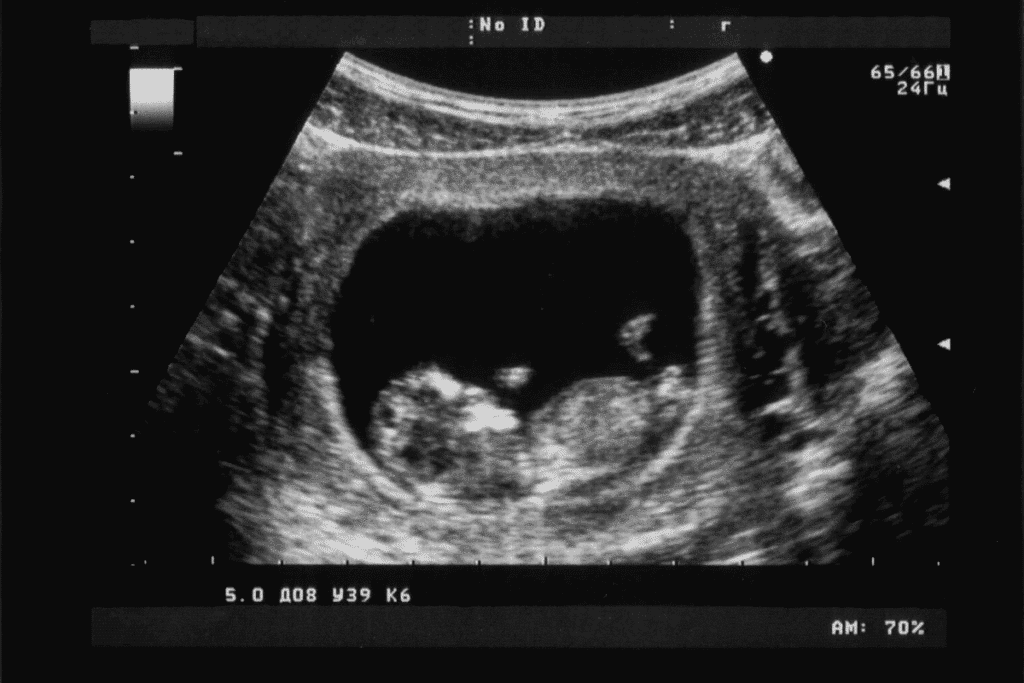 8 Weeks Sonography: What to See