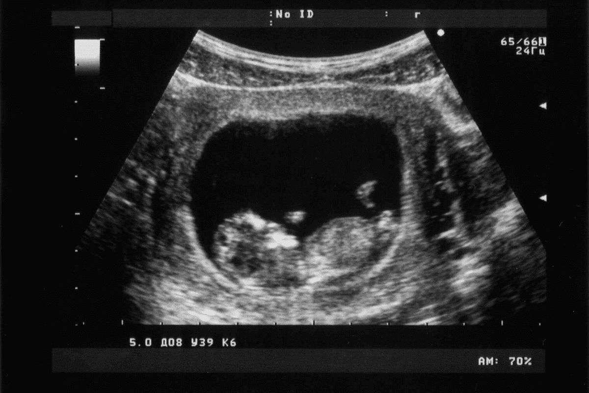Eight Week Ultrasound: What You Can See