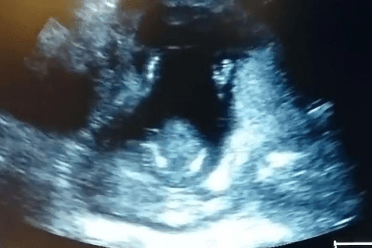 8 Week Ultrasound: What to Expect