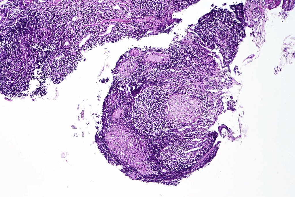 Tongue Fungus Autoimmune Disease: 5 Alarming Signs