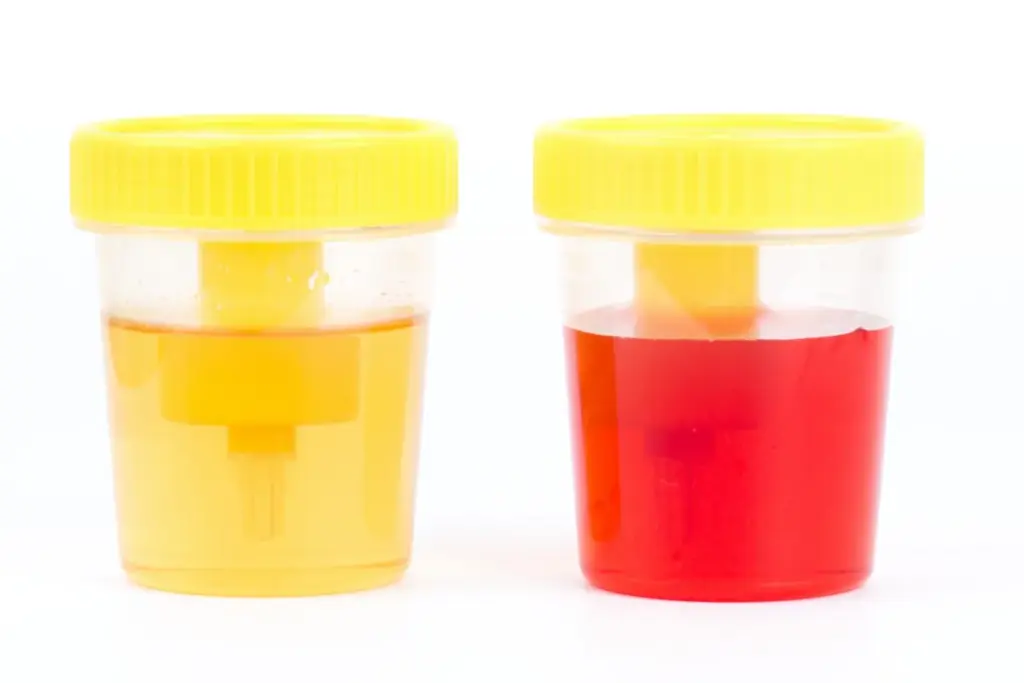 Hematuria vs Kidney Failure: The Truth