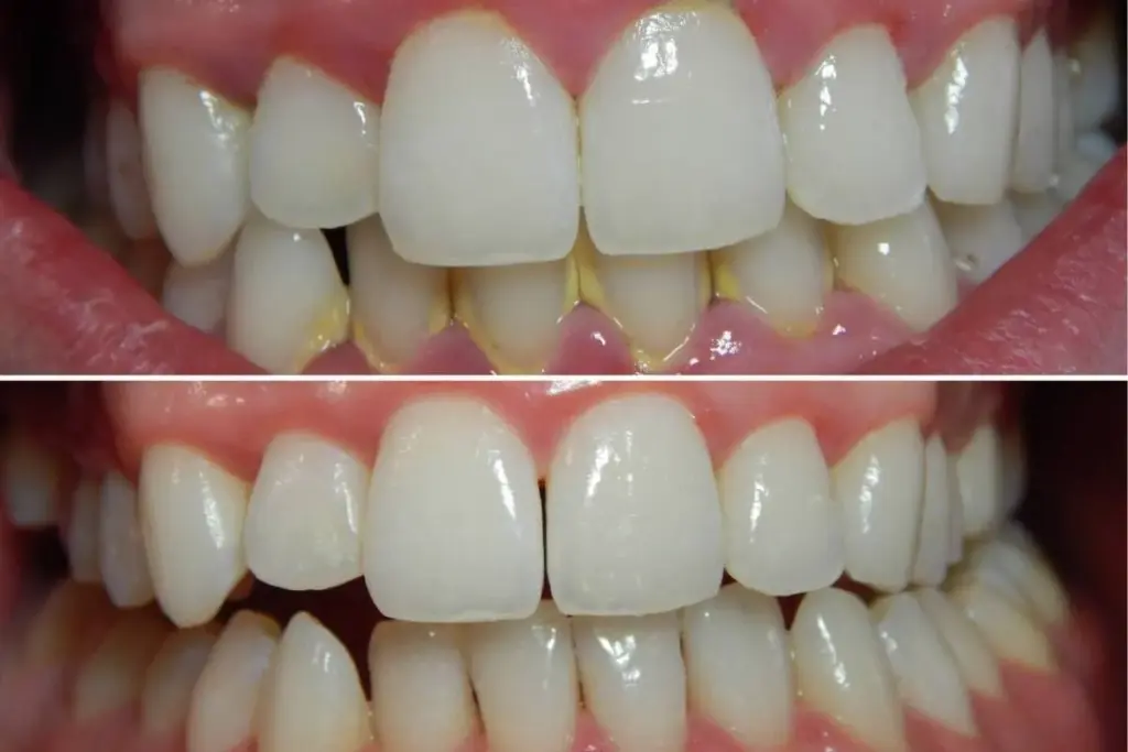 Prostate Biopsy Recovery: What Is Normal?