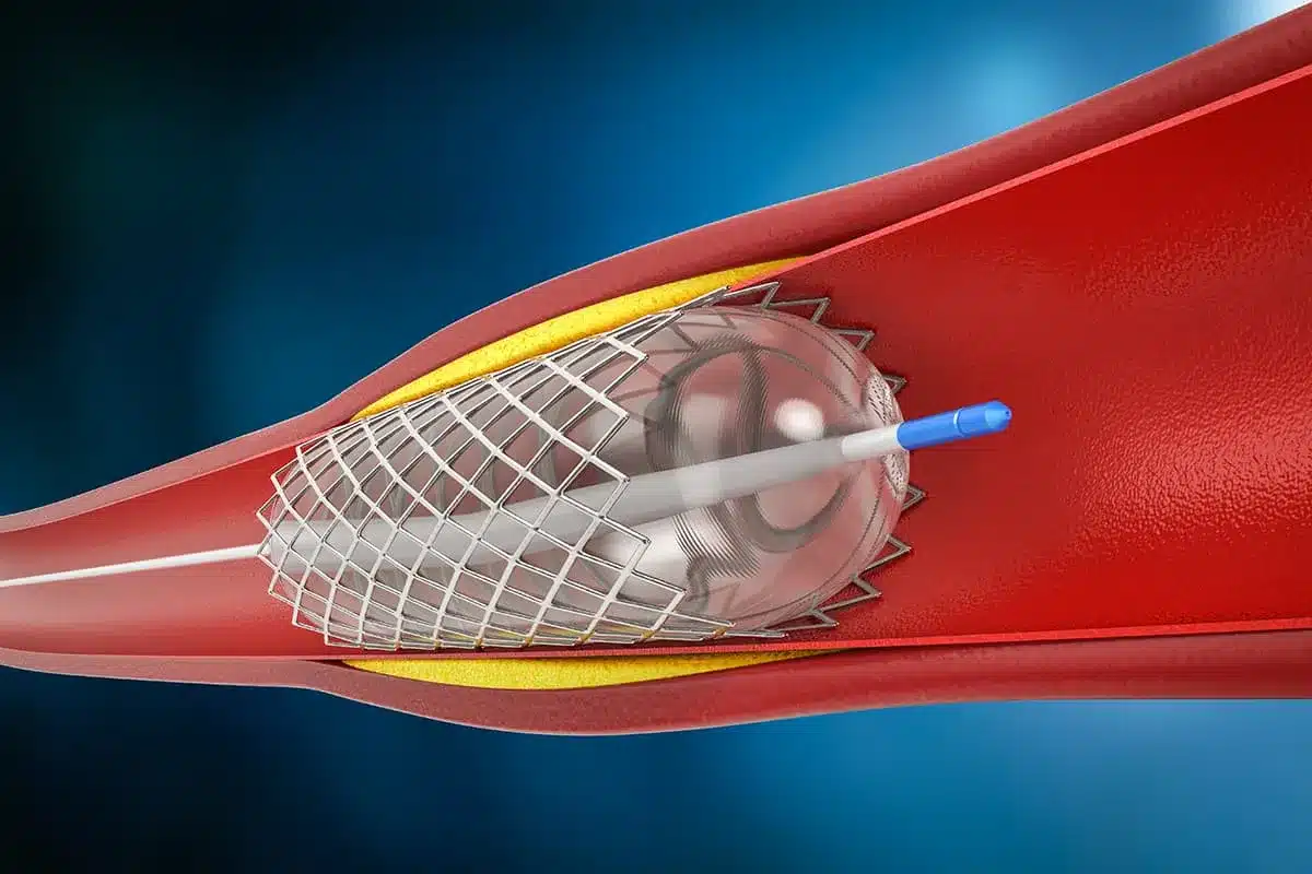 Risk Of Death During Stent Procedure: Facts