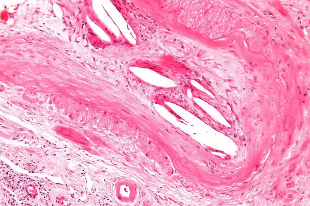 Sharp Do Fibroids Shrink After Menopause (Fibroids Menopause)? 2 Sharp Do Fibroids Shrink After Menopause (Fibroids Menopause)?