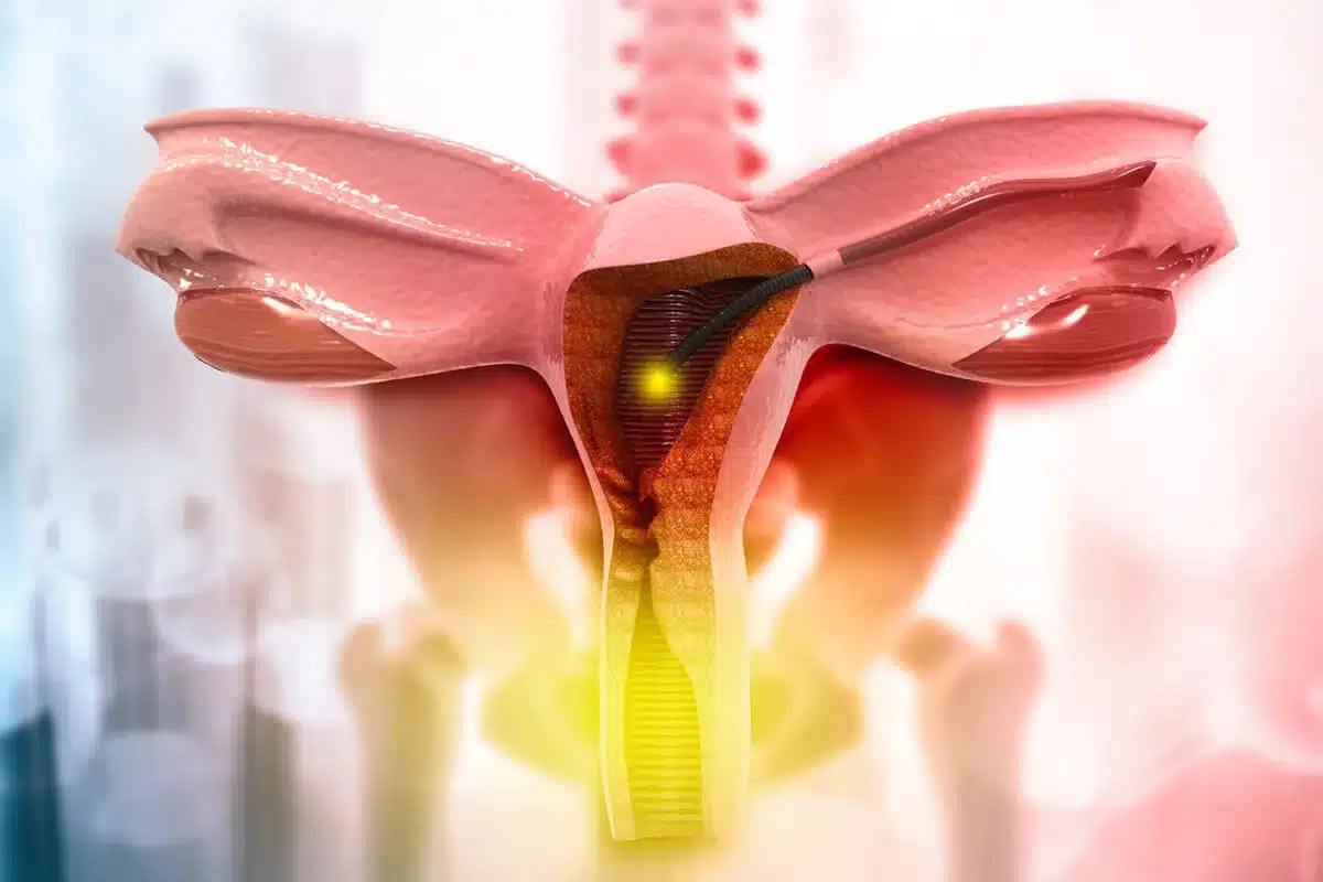 Sharp Do Fibroids Shrink After Menopause (Fibroids Menopause)?