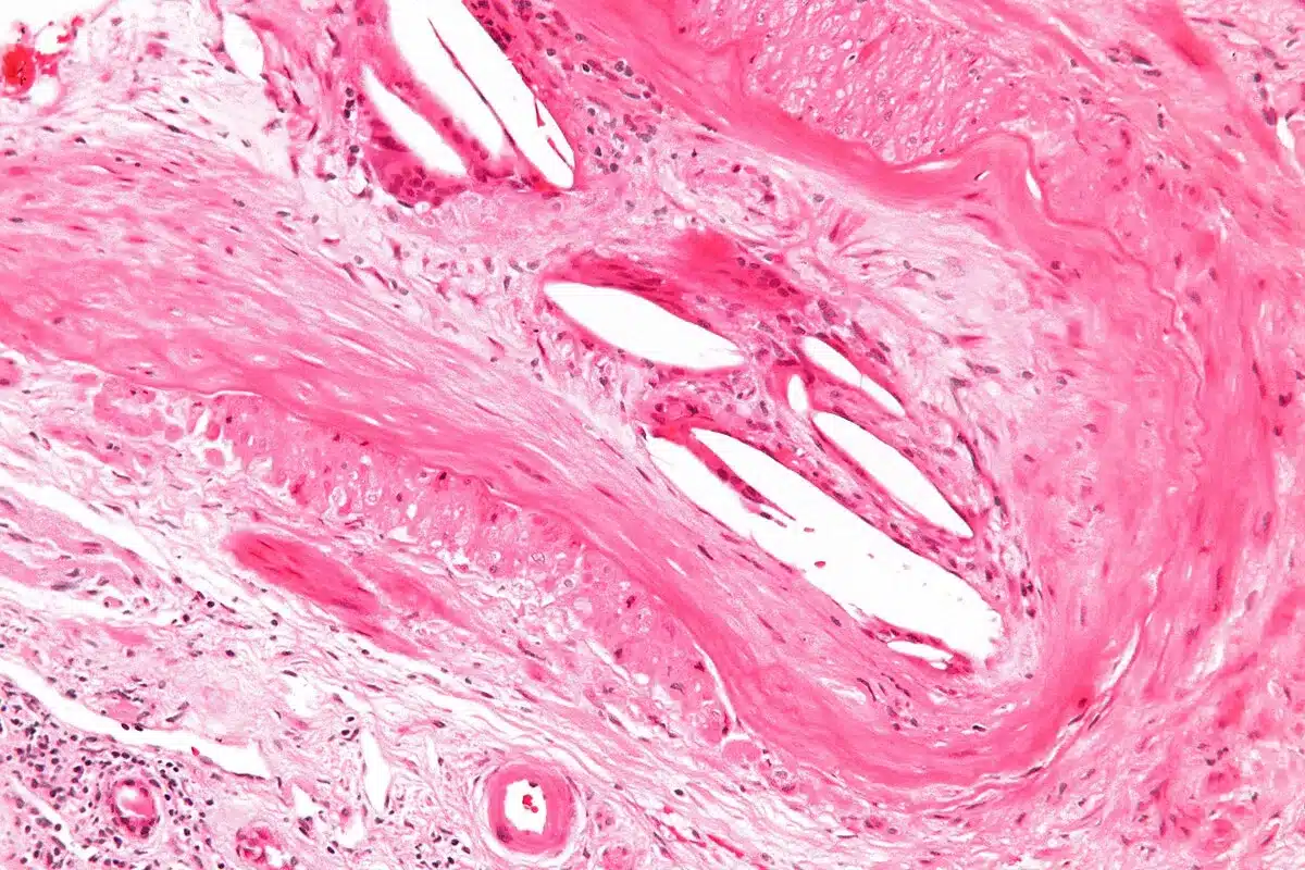 Varicocele Embolization Success