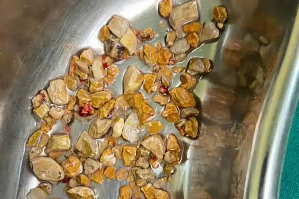 Key What Is A Stent Used For In The Stomach: What Is Stent?